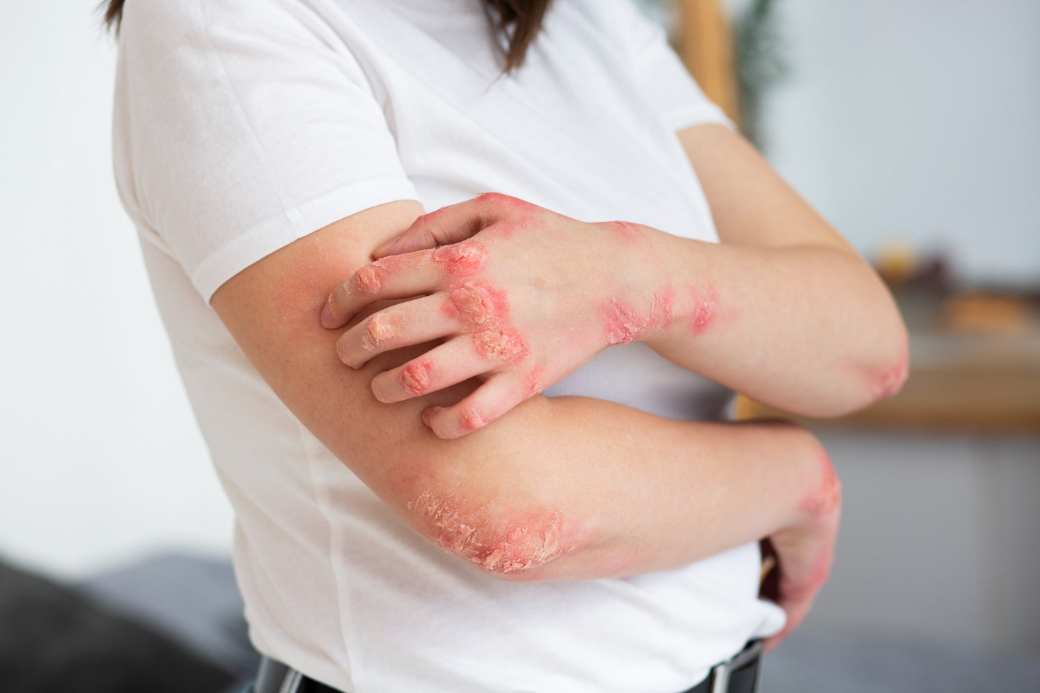 Understanding Eczema: Symptoms, Causes & How to Manage It Naturally (2026)