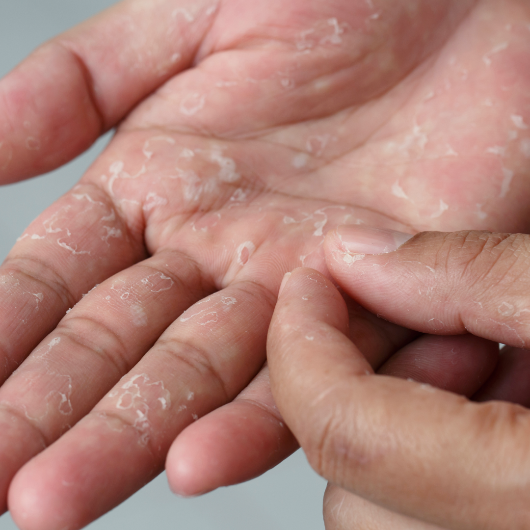 A hand with dry, flaking skin and peeling patches, highlighting the need for a soothing, natural lotion for eczema.