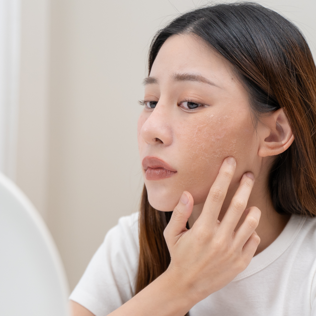 Close-up of a woman examining flaking skin on her cheek, needing a soothing moisturizer for sensitive skin.