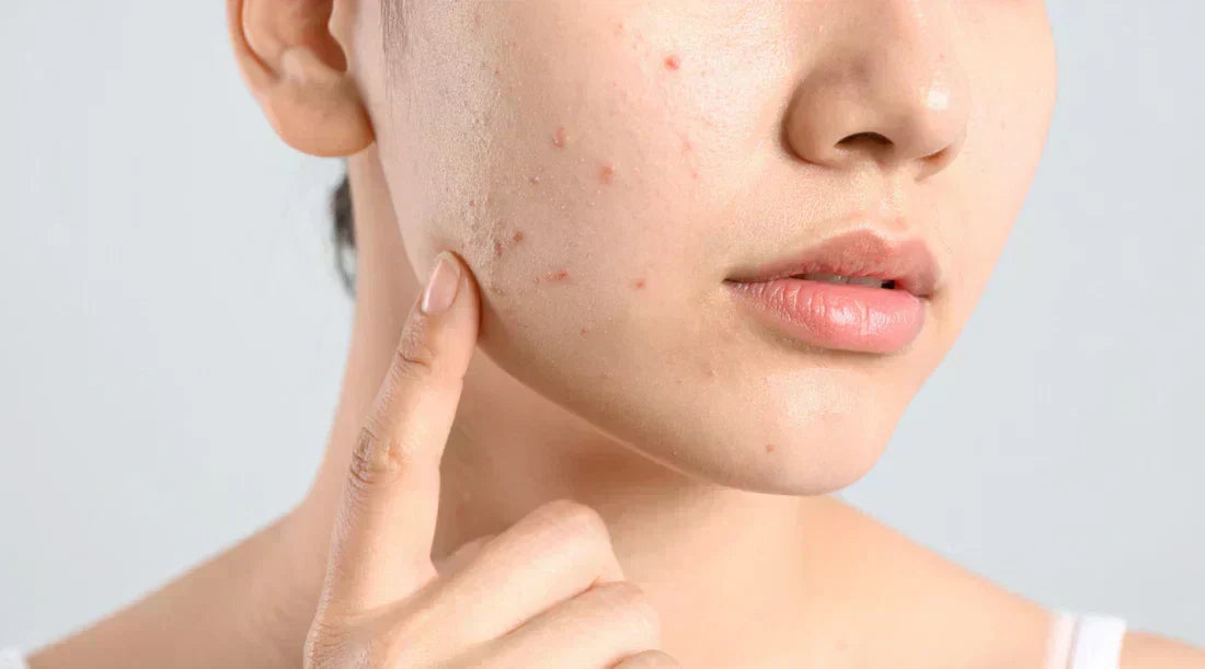 Acne-Prone Skin: How to Build a Simple, Natural Routine That Works for 2026?