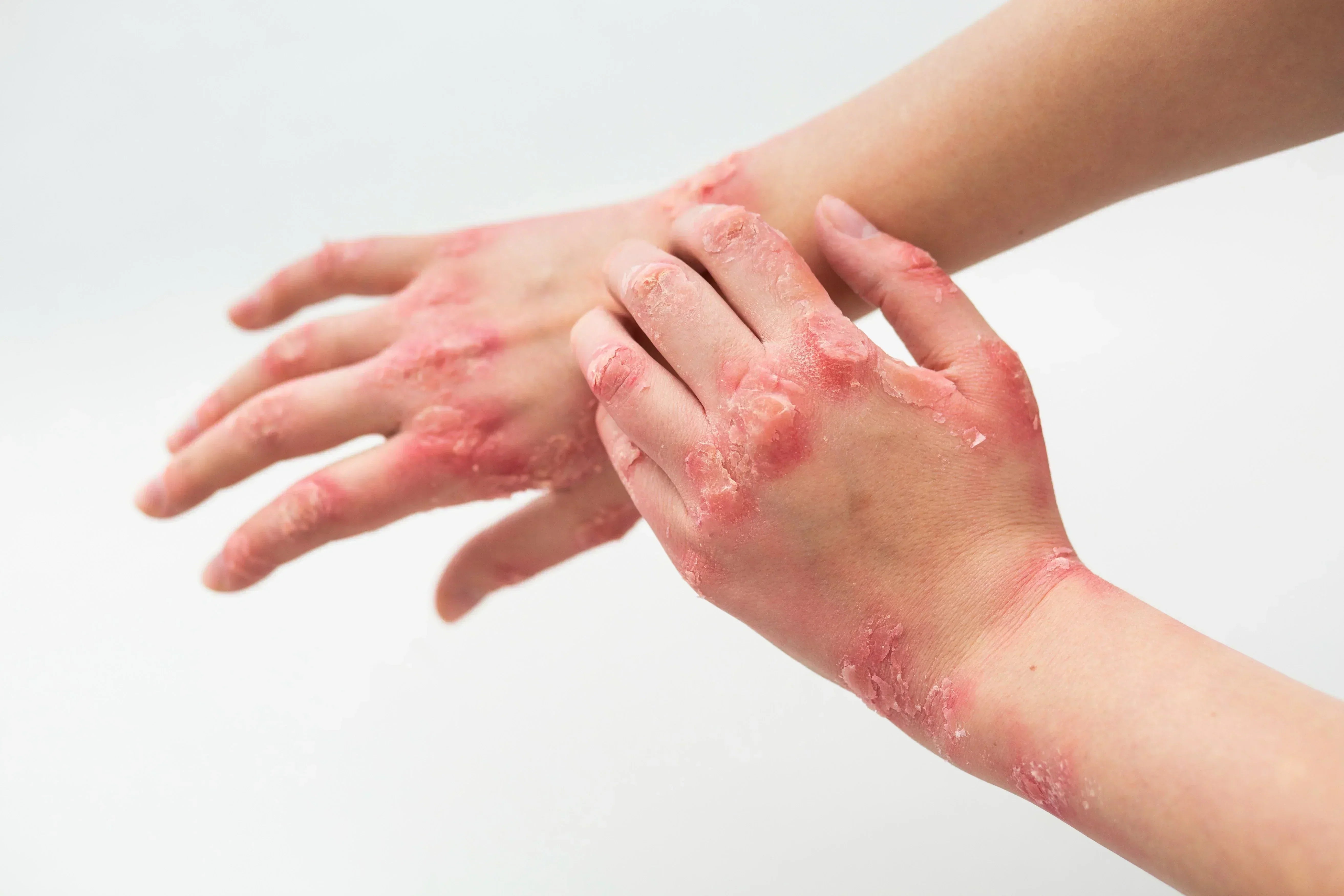 Severe red patches and peeling skin on a person's hands and wrists, needing the best cream for eczema itching.