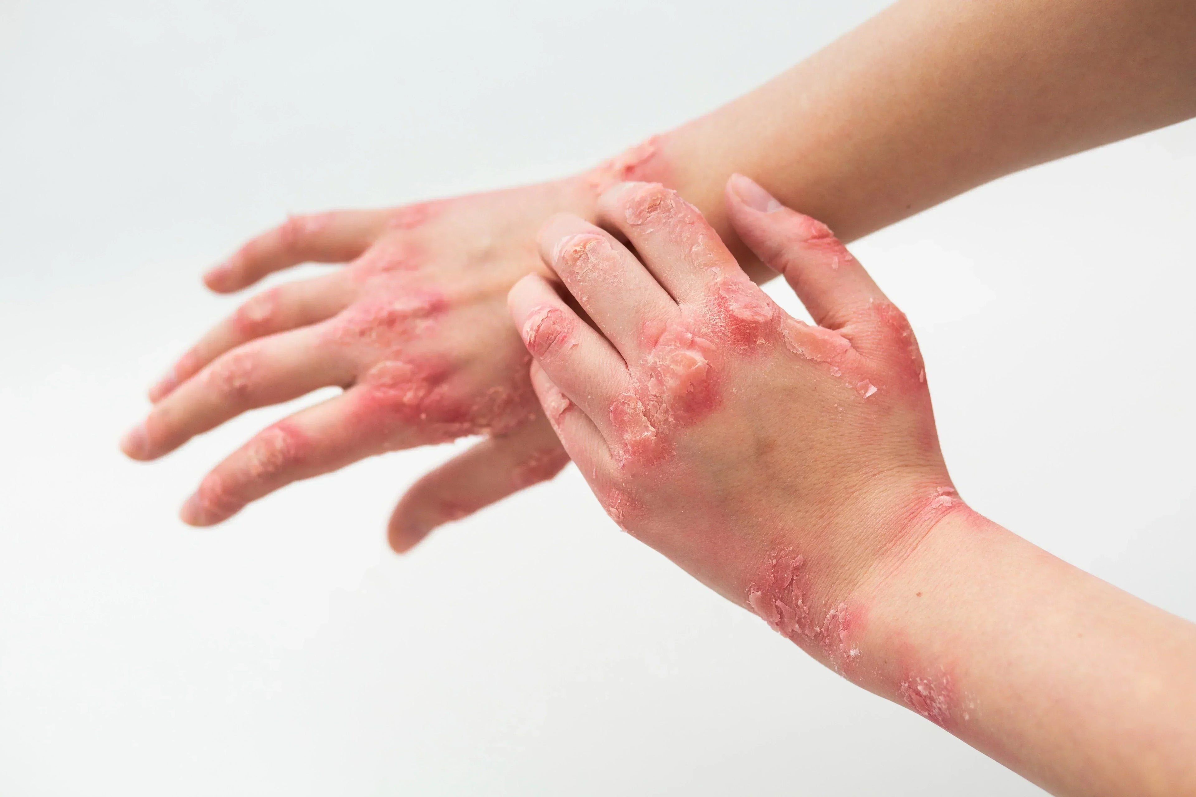 Severe red patches and peeling skin on a person's hands and wrists, needing the best cream for eczema itching.