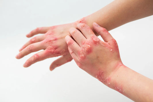 Overcoming Sensitive Skin with e’lioe 2-Step Natural Care Solution