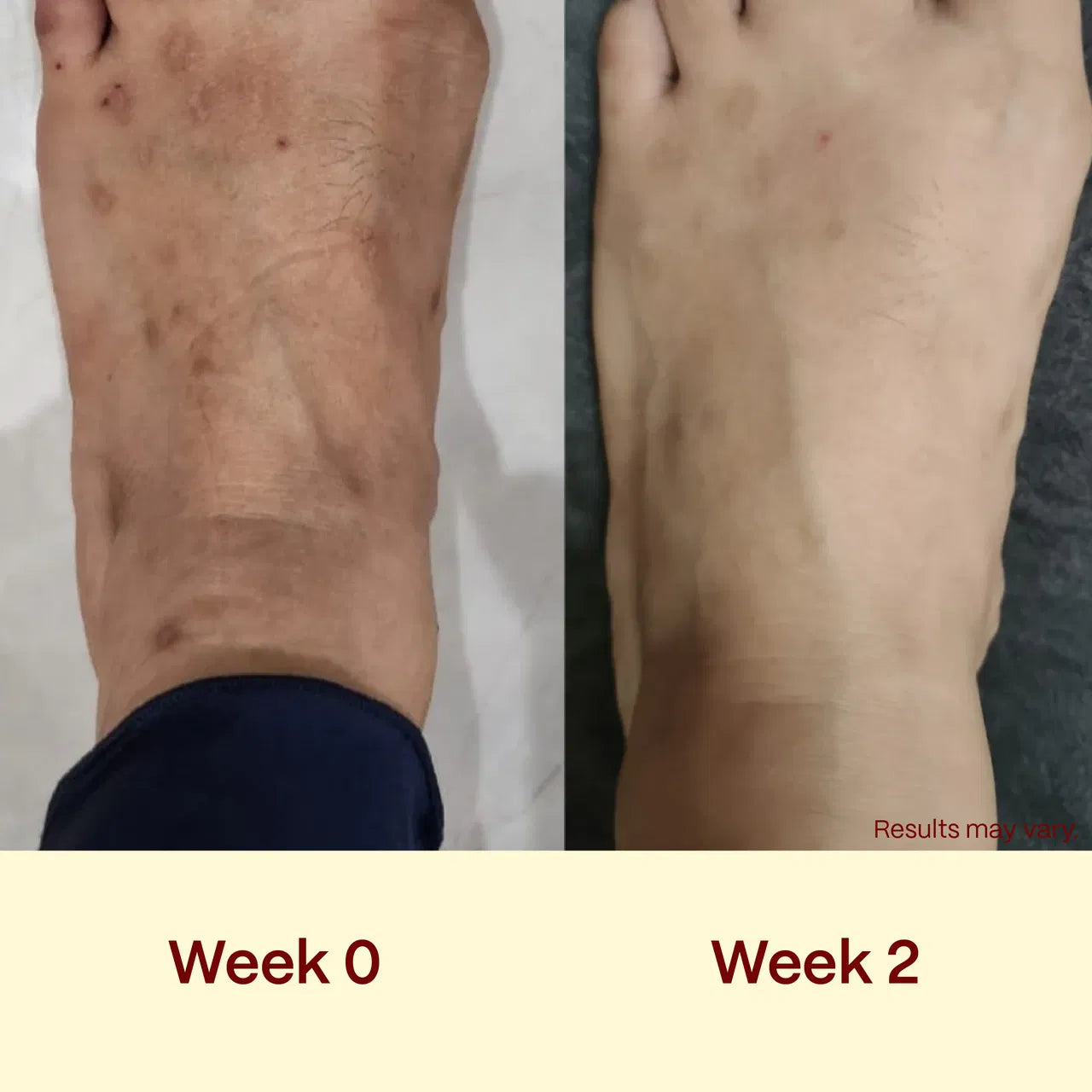 stopped using steroid creams