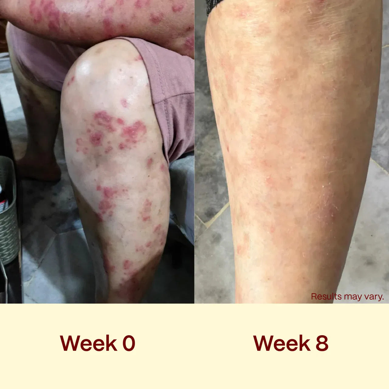 the solution that my psoriasis